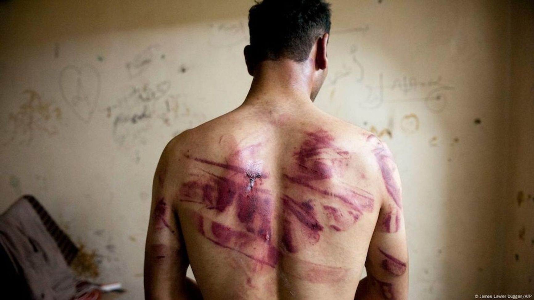 A torture victim in one of the Syrian prisons